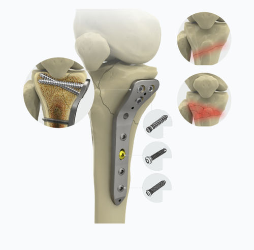 Placca di compressione prossimale - 1572 series - Zimed Medical - per tibia / mediale / bloccata