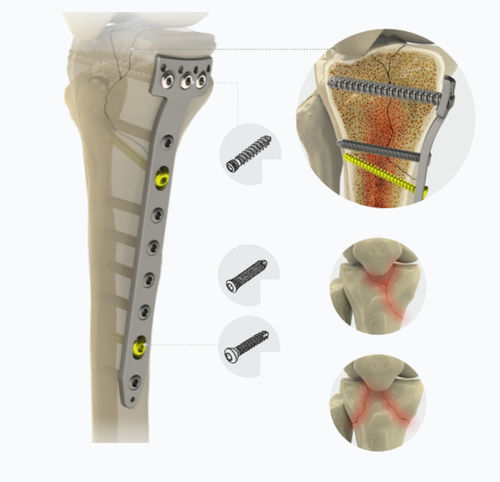 Placca di compressione prossimale - 1792 series - Zimed Medical - per tibia / mediale / bloccata