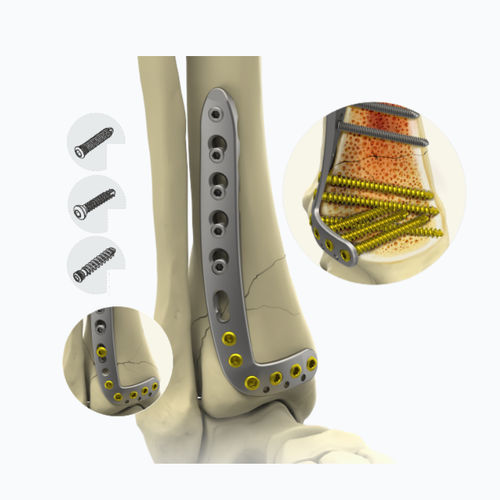 Placca di compressione per tibia - 10132 series - Zimed Medical - distale / anterolaterale / bloccata
