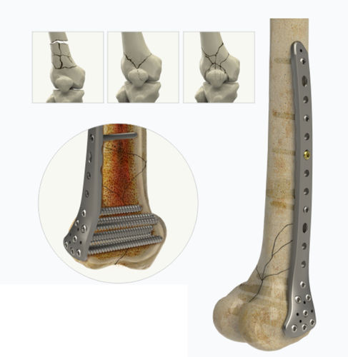 Placca di compressione per femore - 1542 series - Zimed Medical - distale / laterale / bloccata