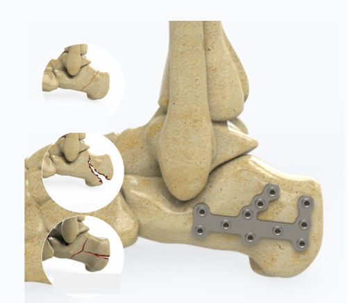 Placca di compressione per calcagno - 1602 series - Zimed Medical - bloccata / in metallo