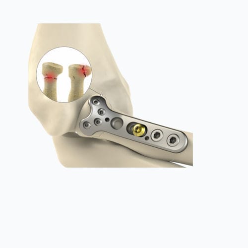 Placca di compressione per radio - 8762 series - Zimed Medical - per capo radiale / prossimale / bloccata