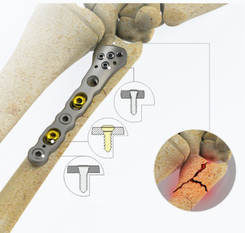 Placca di compressione per ulna - 8732 series - Zimed Medical - distale / bloccata / in metallo