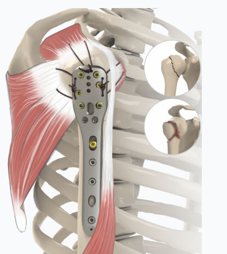 Placca di compressione per omero - 1832 series - Zimed Medical - prossimale / laterale / bloccata