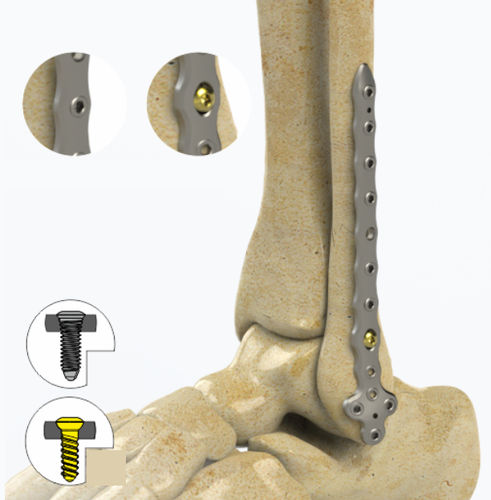 Placca di compressione per fibula - 1852 series - Zimed Medical - distale / bloccata / in metallo