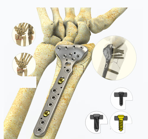 Placca di compressione per radio - 9922 series - Zimed Medical - distale / bloccata / in metallo