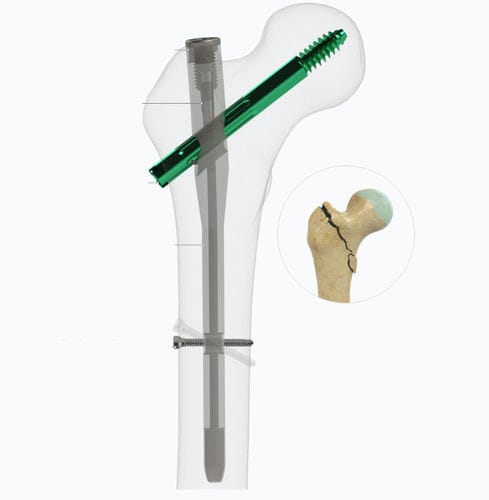 Chiodo intramidollare per femore - Zimed Medical - fissazione prossimale / in metallo