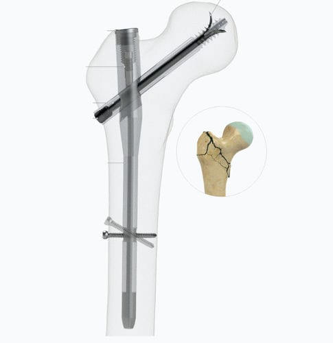 Chiodo intramidollare per femore - Zimed Medical - fissazione prossimale / destro / sinistro