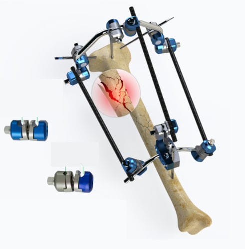 Fissatore esterno per tibia - Zimed Medical - tubolare / per adulti