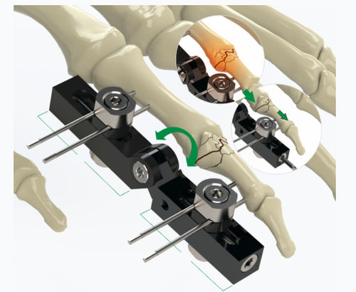 Fissatore esterno per articolazione metacarpo-falangea - 5084-0000 - Zimed Medical - tubolare / per adulti