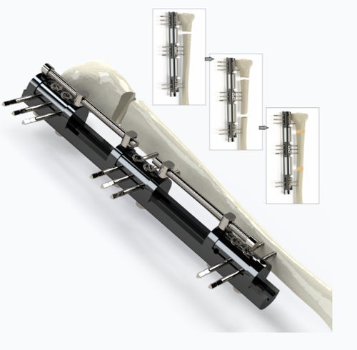 Fissatore esterno per tibia - 5074 series - Zimed Medical - tubolare / per adulti