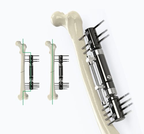 Fissatore esterno per tibia - 5014 series - Zimed Medical - per femore / tubolare / per adulti