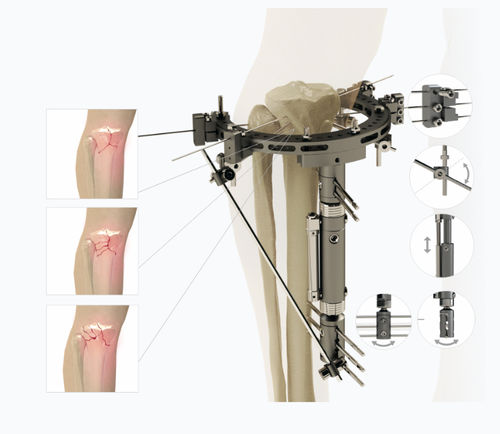 Fissatore esterno per tibia - 5254 series - Zimed Medical - per femore / ibrido / per adulti