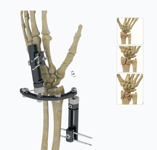 Fissatore esterno per polso - 5134-0000  - Zimed Medical - ibrido / per adulti