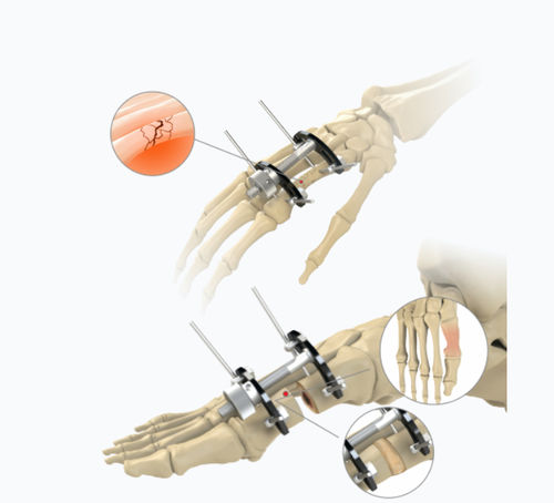 Fissatore esterno per articolazione metacarpo-falangea - 5784-0000	 - Zimed Medical - per articolazione metatarso-falangea / ibrido / per adulti