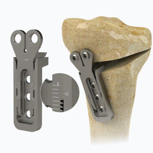 Placca per osteotomia per tibia - 1972-0016 - Zimed Medical - bloccata / in metallo