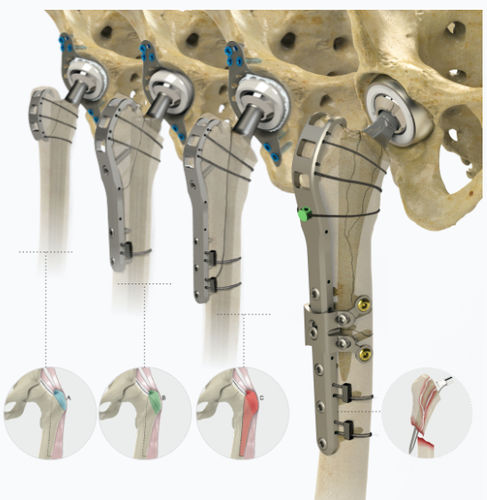 Placca di compressione per femore - Zimed Medical