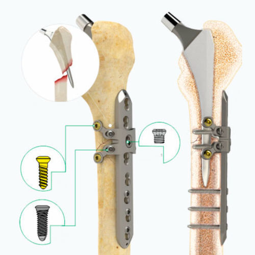 Placca di compressione per tibia - 2912-5000 - Zimed Medical - bloccata / in metallo