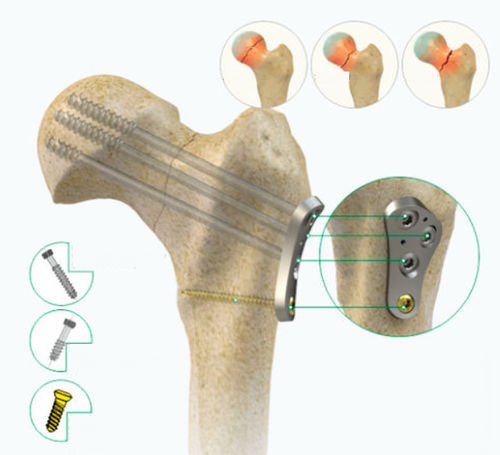 Placca di compressione per testa del femore - Zimed Medical - prossimale / laterale / bloccata