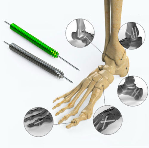Vite per compressione ossea per piede - Zimed Medical - canalare / senza testa / in metallo