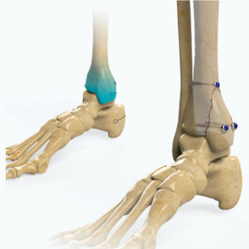 Vite per compressione ossea per piede - Zimed Medical - canalare