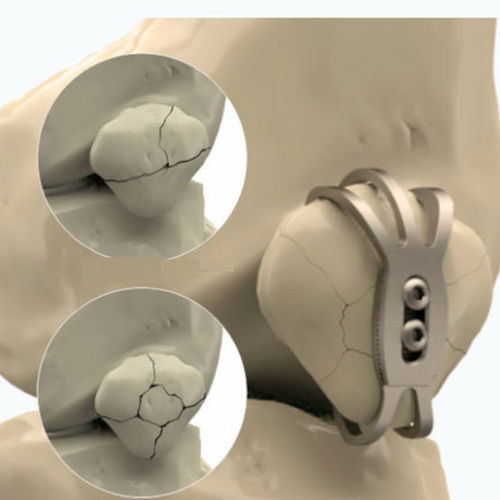 Placca di compressione per rotula - 1072 series - Zimed Medical - bloccata / in metallo
