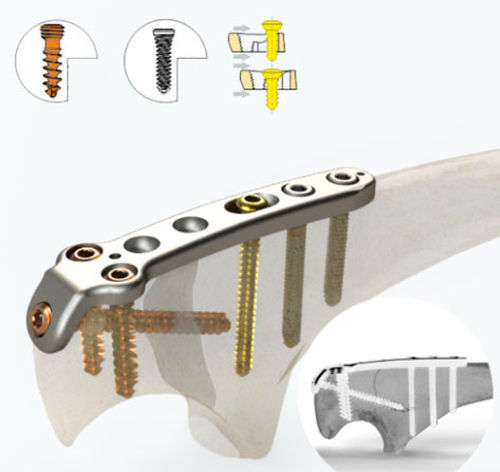 Placca di compressione per ulna - 1662 series - Zimed Medical - per olecrano / prossimale / bloccata