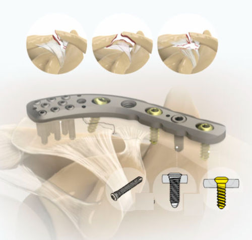 Placca di compressione per clavicola - 1492 series - Zimed Medical - distale / bloccata / in metallo
