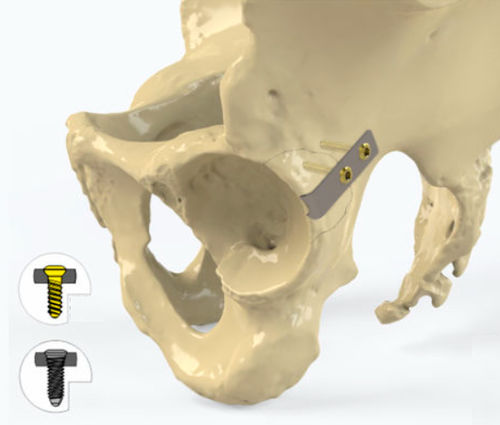 Placca di compressione per acetabolo - Zimed Medical - bloccata / in metallo