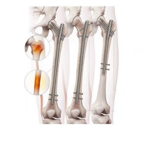Chiodo intramidollare per femore - 4602-0918 - Zimed Medical - fissazione prossimale / fissazione distale / destro