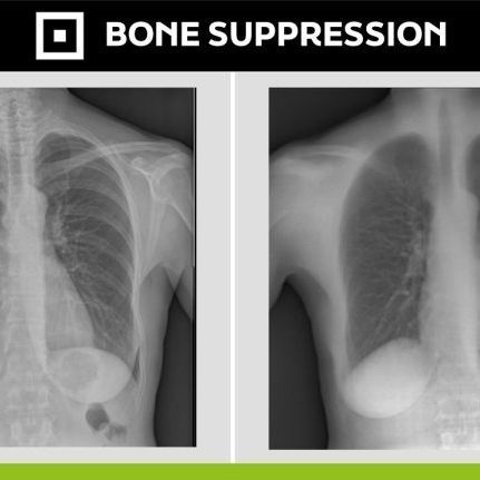 Software medico - Bone Suppression - Digitec - per radiografia / diagnostico / di post elaborazione