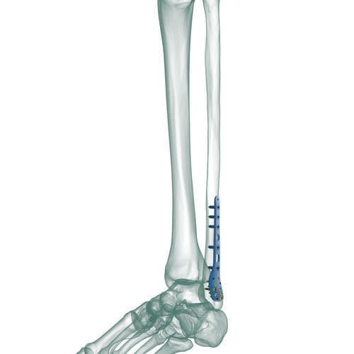Placca di compressione per fibula - TRUE LOCK Distal Fibula Posterolateral - Truemed Medical - distale / posterolaterale / bloccata