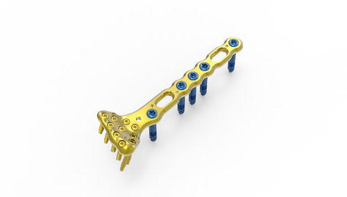 Placca di compressione per polso - TRUE LOCK  - Truemed Medical - distale / bloccata / in metallo