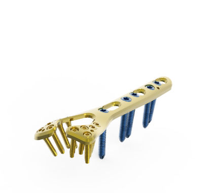 Placca di compressione per radio - TRUE LOCK  - Truemed Medical - distale / dorsale / bloccata