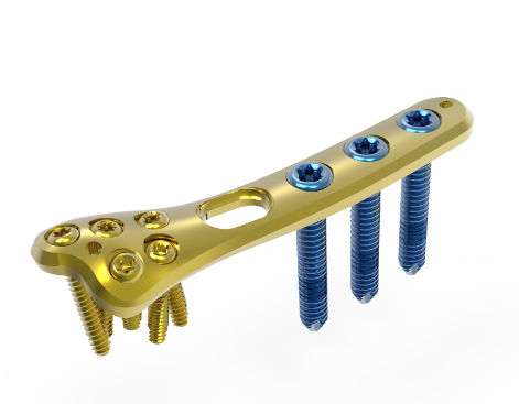 Placca di compressione per ulna - TRUE LOCK  - Truemed Medical - distale / bloccata / in metallo
