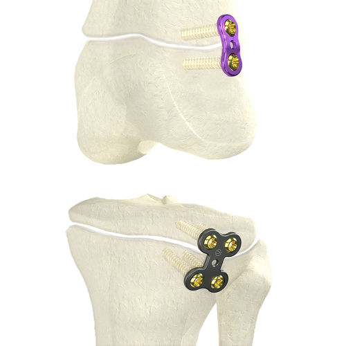 Placca per osteotomia per femore - WishFIX™ - WishBone Medical - per tibia / prossimale / distale