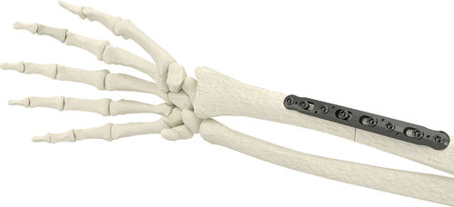Placca di compressione per radio - PK-SCP2704-TI - WishBone Medical - mediale / in metallo / pediatrica