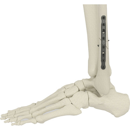Placca per osteotomia per fibula - PK-SFP series - WishBone Medical - mediale / non bloccata / in metallo