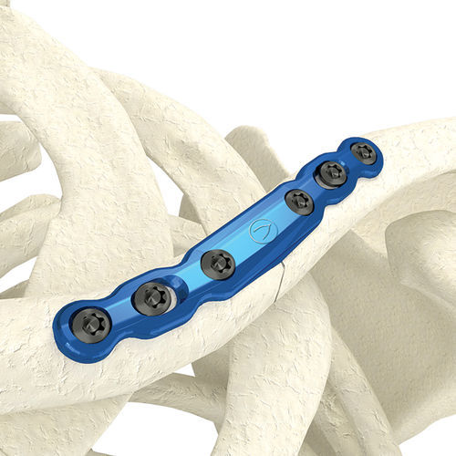 Placca di compressione per clavicola - PK-SMC0635NL-TI - WishBone Medical - mediale / in metallo / pediatrica
