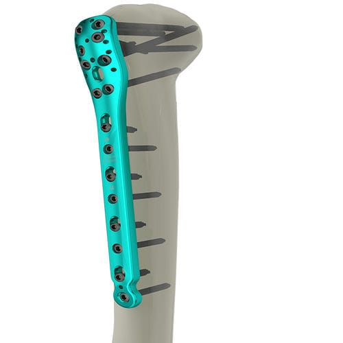 Placca di compressione per omero - 10-2200 series - WishBone Medical - prossimale / bloccata