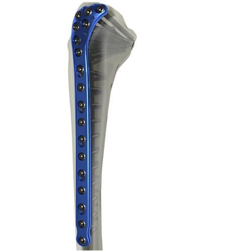Placca di compressione per tibia - WishBone Medical - prossimale / bloccata / in titanio