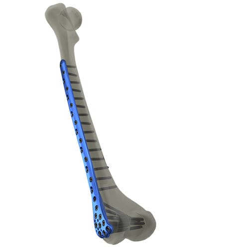 Placca di compressione per femore - WishBone Medical - distale / bloccata / in titanio