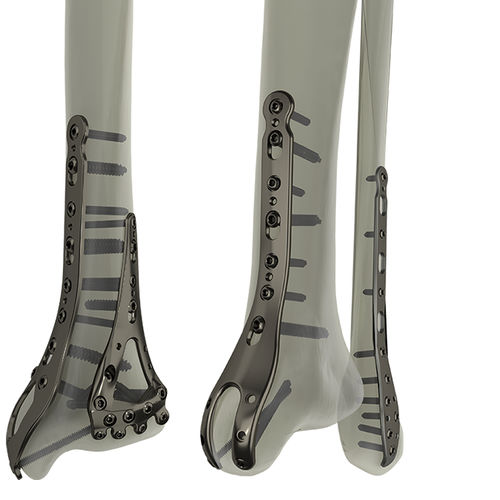 Placca di compressione per tibia - STEP®  - WishBone Medical - per fibula / per malleolo / distale