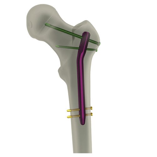 Chiodo intramidollare per femore - PediFIN® - WishBone Medical - fissazione prossimale / pediatrico