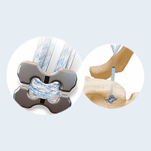 Bottone da sutura per ricostruzione del legamento acromio-clavicolare - EB3F - Star Sports Medicine