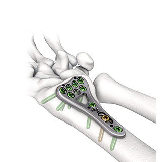 Placca di compressione per radio - Changzhou Dingjian Medical Equipment - distale / bloccata / in metallo
