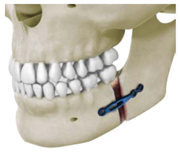 Placca per osteotomia per mandibola - Delphos Implants - in metallo