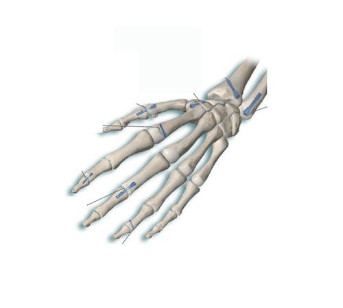 Vite per compressione ossea metacarpale - Delphos Implants - per falange della mano / senza testa / in metallo