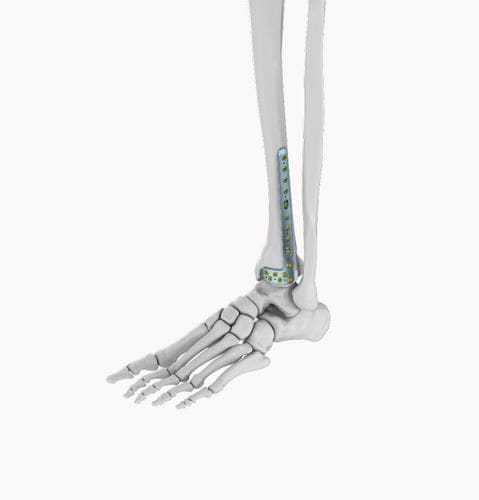 Placca di compressione per tibia - ELT010 - Eonex Medical - distale / anterolaterale / bloccata