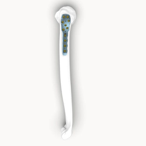 Placca di compressione per omero - Eonex Medical - prossimale / bloccata / non bloccata
